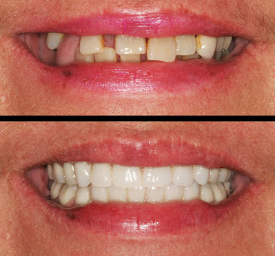 Dental Implants In One Day
